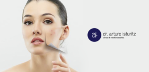 tratamiento del acne clinica Isturitz