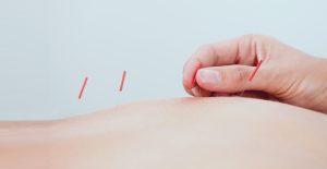 acupunctura - Clínica Isturitz | medicina estética – Donostia San Sebastián