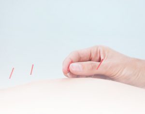 tratamiento acupuntura - Clínica Isturitz | medicina estética – Donostia San Sebastián